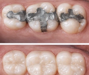 white fillings 1
