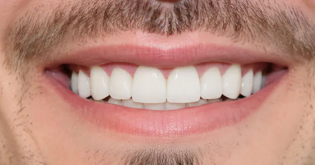 after-full-mouth-restoration-mouth after full mouth restoration mouth